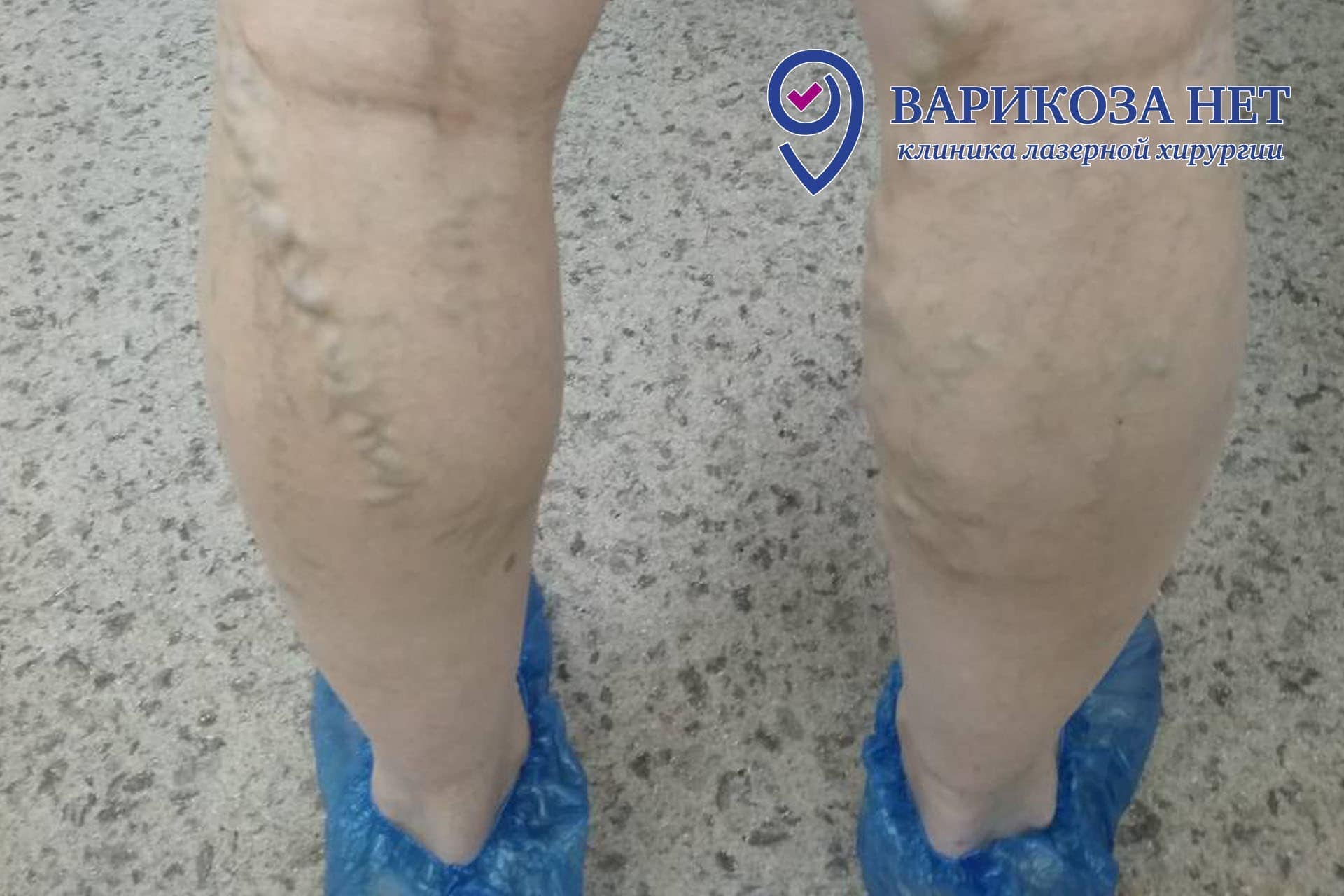 Варикозная болезнь нижних конечностей до лечения и после ЭВЛК на 45-й ...