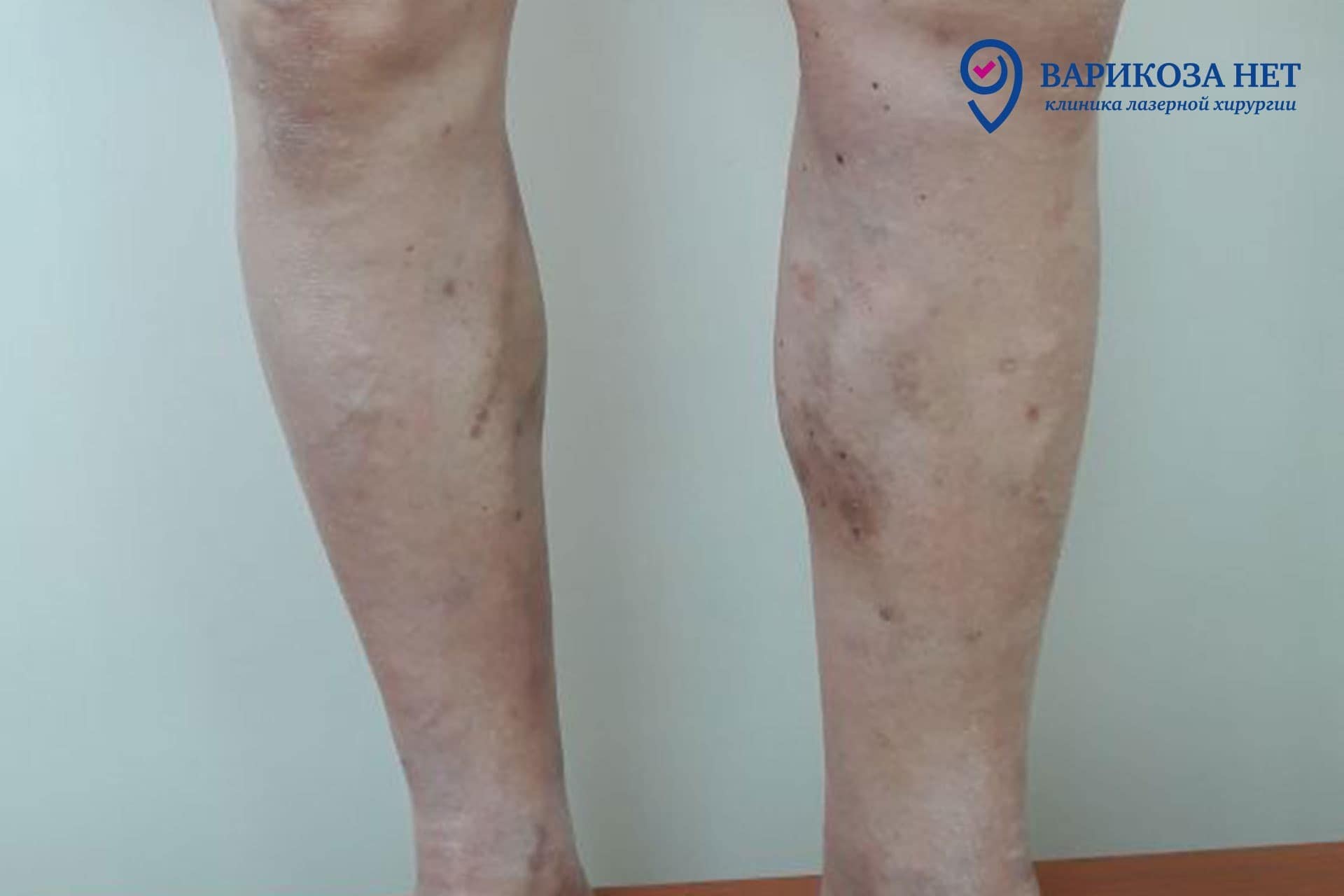 Варикозная болезнь нижних конечностей до лечения и после ЭВЛК на 45-й ...