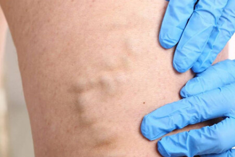 Прием хирурга-флеболога по акции