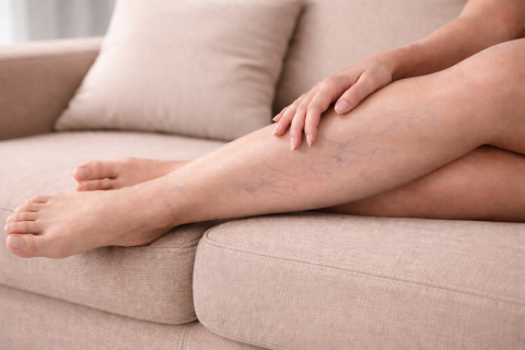 Работа стоя и варикоз - как снизить риски